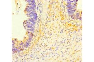 Immunohistochemistry of paraffin-embedded human ovarian cancer using ABIN7174658 at dilution of 1:100