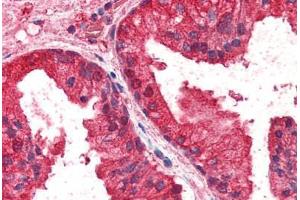 Human Prostate (formalin-fixed, paraffin-embedded) stained with CREB3L4 antibody ABIN337002 at 2. (CREB3L4 anticorps  (AA 382-395))