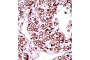 Formalin-fixed and paraffin-embedded human cancer tissue (hepatocarcinoma) reacted with the primary antibody, which was peroxidase-conjugated to the secondary antibody, followed by AEC staining. (CAMKII gamma anticorps  (C-Term))
