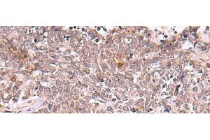 Immunohistochemistry of paraffin-embedded Human lung cancer tissue using TRMT12 Polyclonal Antibody at dilution of 1:80(x200) (TRMT12 anticorps)