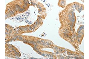 The image on the left is immunohistochemistry of paraffin-embedded Human colon cancer tissue using ABIN7191855(PGBD5 Antibody) at dilution 1/10, on the right is treated with synthetic peptide. (PGBD5 anticorps)