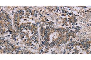 Immunohistochemistry of paraffin-embedded Human liver cancer tissue using AATK Polyclonal Antibody at dilution 1:45 (AATK anticorps)