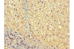 Immunohistochemistry of paraffin-embedded human liver cancer using ABIN7175557 at dilution of 1:100