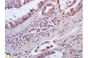 Formalin-fixed and paraffin embedded human lung carcinoma labeled with Anti-CD84/SLAMF5 Polyclonal Antibody, Unconjugated (ABIN741465) at 1:200, followed by conjugation to the secondary antibody and DAB staining