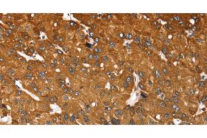 Immunohistochemistry of paraffin-embedded Human liver cancer tissue using RASSF3 Polyclonal Antibody at dilution 1:35 (RASSF3 anticorps)