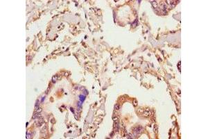 Immunohistochemistry of paraffin-embedded human pancreatic cancer using ABIN7141994 at dilution of 1:100 (MICAL2 anticorps  (AA 1-495))