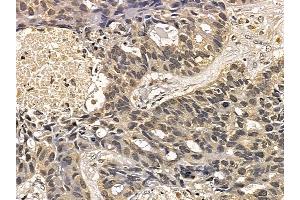 AurB Mouse Monoclonal Antibody at 1/100 staining human lung cancer and adjacent non-tumor tissue by IHC-P. (Aurora Kinase B anticorps  (N-Term))