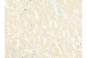 ABIN6265620 and ABIN6278644 at 1/100 staining human renal cell carcinoma by IHC-P. (TMPRSS3 anticorps  (Internal Region))