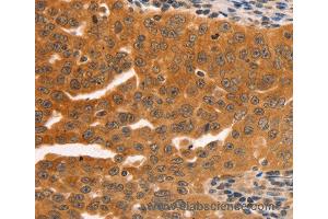 Immunohistochemistry of Human ovarian cancer using SERPINB5 Polyclonal Antibody at dilution of 1:60 (SERPINB5 anticorps)