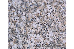 Immunohistochemistry of Human lung cancer using TP53AIP1 Polyclonal Antibody at dilution of 1:50 (TP53AIP1 anticorps)
