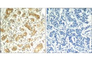 Immunohistochemical analysis of paraffin-embedded human breast carcinoma tissue using syk (Ab-323) Antibody (E021546). (SYK anticorps)