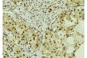 ABIN6267097 at 1/100 staining Human breast cancer tissue by IHC-P.
