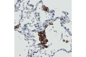 Immunohistochemical staining (Formalin-fixed paraffin-embedded sections) of human lung with MRC1 monoclonal antibody, clone CL0387  shows strong immunoreactivity in macrophages. (Macrophage Mannose Receptor 1 anticorps)