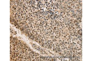 Immunohistochemistry of Human lung cancer using CDCA8 Polyclonal Antibody at dilution of 1:40 (CDCA8 anticorps)