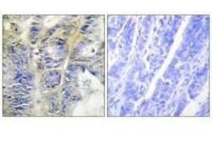 Immunohistochemistry analysis of paraffin-embedded human colon carcinoma tissue using Collagen IV α5 antibody. (COL4a5 anticorps)
