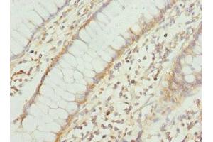 Immunohistochemistry of paraffin-embedded human colon cancer using ABIN7166573 at dilution of 1:100