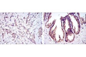 Immunohistochemical analysis of paraffin-embedded breast cancer tissues (left) and prostate tissues (right) using MAP3K5 mouse mAb with DAB staining.
