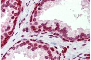 Human Prostate (formalin-fixed, paraffin-embedded) stained with BXDC5 antibody ABIN462228 followed by biotinylated goat anti-rabbit IgG secondary antibody ABIN481713, alkaline phosphatase-streptavidin and chromogen.