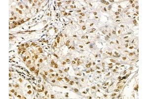 Phospho-EEF1A2 (Ser358) Antibody at 1/100 staining Human liver cancer by IHC-P. (EEF1A2 anticorps  (pSer358))