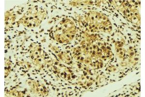 ABIN6276841 at 1/100 staining Human breast cancer tissue by IHC-P. (MED1 anticorps  (Internal Region))
