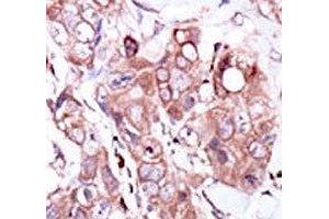 IHC analysis of FFPE human breast carcinoma tissue stained with the ERBB4 antibody (ERBB4 anticorps  (AA 1276-1308))