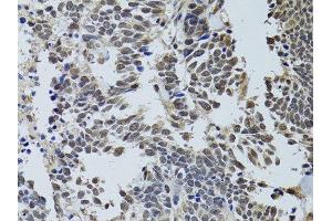 Immunohistochemistry of paraffin-embedded human lung cancer using STK11 antibody.