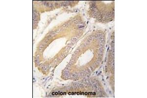 Formalin-fixed and paraffin-embedded human colon carcinoma tissue reacted with FGF4 Antibody (C-term) (ABIN392776 and ABIN2842218) , which was peroxidase-conjugated to the secondary antibody, followed by DAB staining.