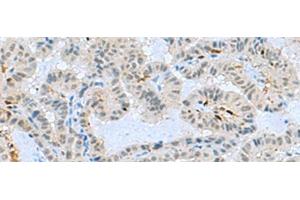 Immunohistochemistry of paraffin-embedded Human thyroid cancer tissue using TCF19 Polyclonal Antibody at dilution of 1:60(x200) (TCF19 anticorps)
