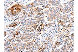 The image on the left is immunohistochemistry of paraffin-embedded Human breast cancer tissue using ABIN7190683(FOXD2 Antibody) at dilution 1/10, on the right is treated with synthetic peptide. (FOXD2 anticorps)