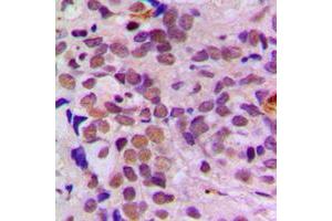 Immunohistochemical analysis of ATF1 staining in human breast cancer formalin fixed paraffin embedded tissue section.