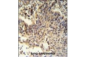 RXRA Antibody (Center) (ABIN651113 and ABIN2840079) IHC analysis in formalin fixed and paraffin embedded lung carcinoma followed by peroxidase conjugation of the secondary antibody and DAB staining. (Retinoid X Receptor alpha anticorps  (AA 196-224))