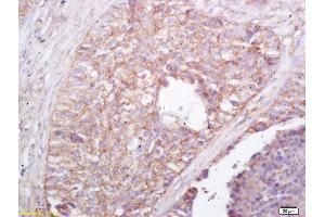 Formalin-fixed and paraffin embedded human lung carcinoma labeled with Rabbit Anti NALP4 Polyclonal Antibody, Unconjugated  at 1:200 followed by conjugation to the secondary antibody and DAB staining