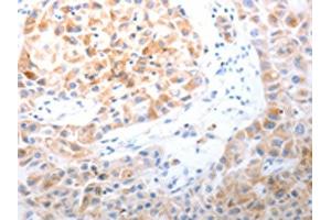 The image on the left is immunohistochemistry of paraffin-embedded Human lung cancer tissue using ABIN7191313(LPPR5 Antibody) at dilution 1/20, on the right is treated with synthetic peptide. (LPPR5 anticorps)
