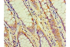 Immunohistochemistry of paraffin-embedded human colon cancer using ABIN7171365 at dilution of 1:100