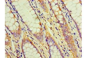 Immunohistochemistry of paraffin-embedded human colon cancer using ABIN7171365 at dilution of 1:100 (CD2 anticorps  (AA 25-209))