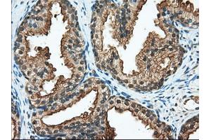 Immunohistochemical staining of paraffin-embedded Adenocarcinoma of Human ovary tissue using anti-RANGAP1 mouse monoclonal antibody.
