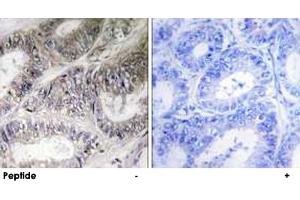 Immunohistochemistry analysis of paraffin-embedded human colon carcinoma tissue using COX19 polyclonal antibody . (COX19 anticorps)