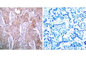 Immunohistochemical analysis of paraffin- embedded breast carcinoma, using EGFR (Phospho-Ser1070) Antibody. (EGFR anticorps  (pSer1070))