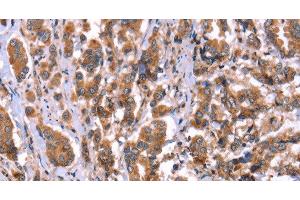 Immunohistochemistry of paraffin-embedded Human breast cancer tissue using HRG Polyclonal Antibody at dilution 1:50 (HRG anticorps)