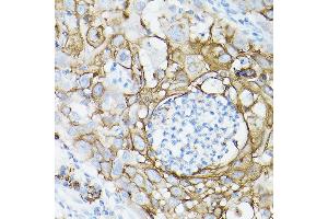 Immunohistochemistry of paraffin-embedded human lung cancer using MUC1 Rabbit mAb (ABIN7268687) at dilution of 1:100 (40x lens). (MUC1 anticorps)