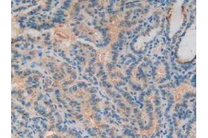 Detection of C3 in Human Thyroid Cancer Tissue using Polyclonal Antibody to Complement Component 3 (C3)