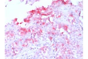 Formalin-fixed, paraffin-embedded human Melanoma stained with MART-1 Rabbit Recombinant Monoclonal Antibody (MLANA/1761R) (AP-Fast Red). (Recombinant MLANA anticorps)