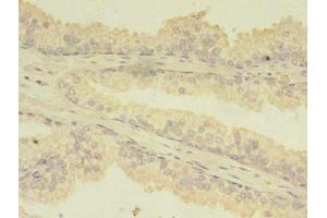 Immunohistochemistry of paraffin-embedded human prostate cancer using ABIN7173738 at dilution of 1:100 (TBCA anticorps  (AA 2-108))