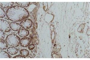Immunohistochemistry of paraffin-embedded Human colon carcinoma tissue using HSPA5 Monoclonal Antibody at dilution of 1:200. (GRP78 anticorps)