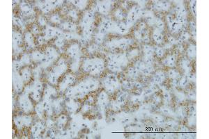 Immunoperoxidase of monoclonal antibody to C1GALT1 on formalin-fixed paraffin-embedded human hepatocellular carcinoma. (C1GALT1 anticorps  (AA 264-363))