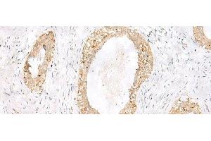 Immunohistochemistry of paraffin-embedded Human breast cancer tissue using TOR1A Polyclonal Antibody at dilution of 1:35(x200) (TOR1A anticorps)