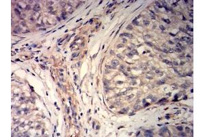 Immunohistochemical analysis of paraffin-embedded bladder Cancer tissues using MYLK mouse mAb with DAB staining. (MYLK anticorps  (AA 1375-1524))