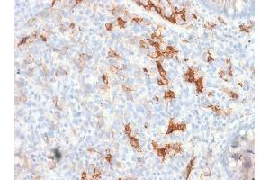 Formalin-fixed, paraffin-embedded human Melanoma stained with NGFR Rabbit Recombinant Monoclonal Antibody (NGFR/1997R).