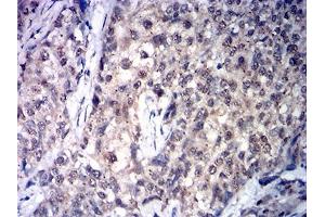 Immunohistochemical analysis of paraffin-embedded cervical cancer tissues using SDHB mouse mAb with DAB staining. (SDHB anticorps  (AA 29-280))