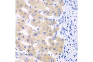 Immunohistochemistry of paraffin-embedded human liver cancer using CYP2C18 antibody. (CYP2C18 anticorps  (AA 231-490))